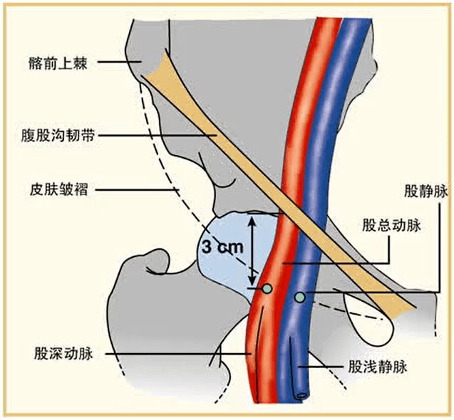 腹股沟管皮下环图片