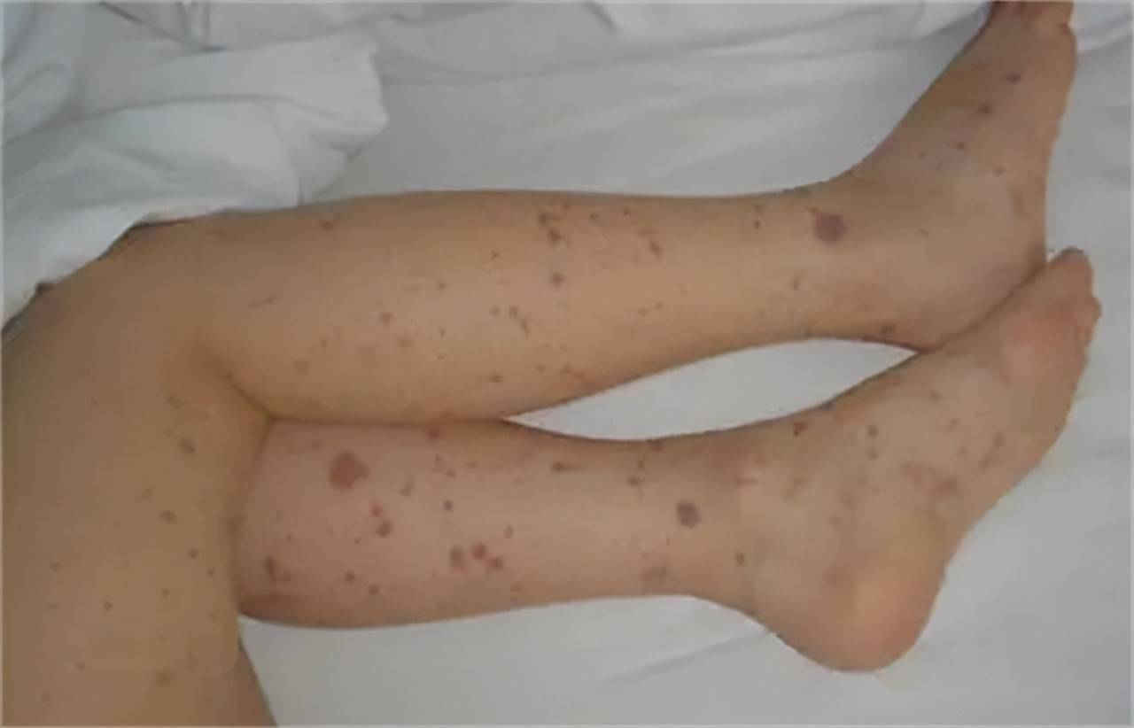 身上出现很多小红点，不痛不痒是怎么回事？听听医生怎么说_身体_患者_症状