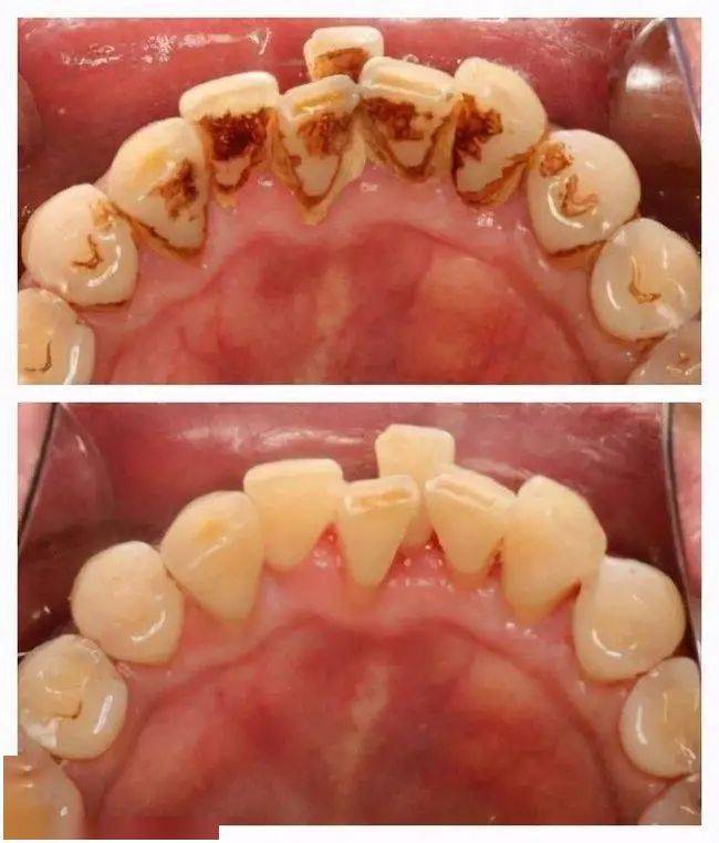 家家都有這材料_蛋殼_牙齒_牙釉質