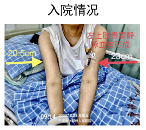 67picc并发静脉血栓抗凝治疗要多久拔管时血栓会脱落吗