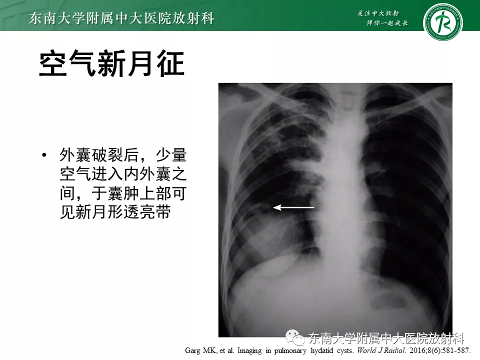 支气管囊肿x线表现图片