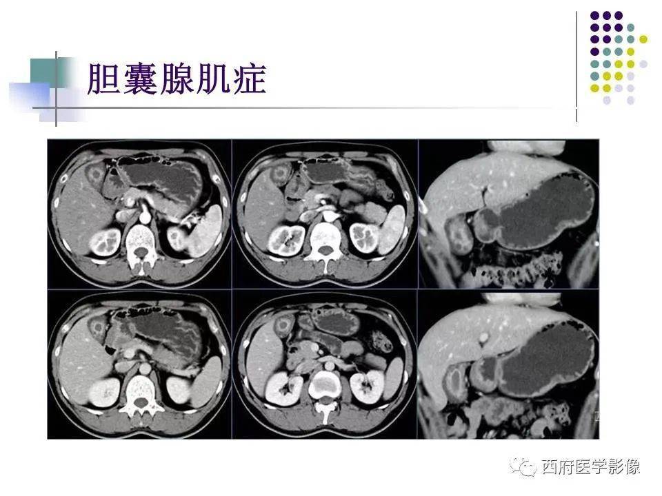 下腔静脉b超的解剖图图片