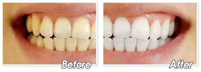 喷头|?蜂胶喷剂 呵护口腔健康