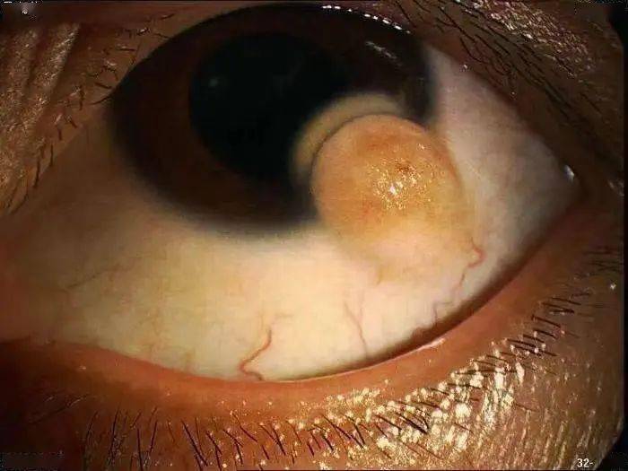 性生活并非 hpv 感染唯一途径!9 价疫苗现货,速来_接种_传播_病毒