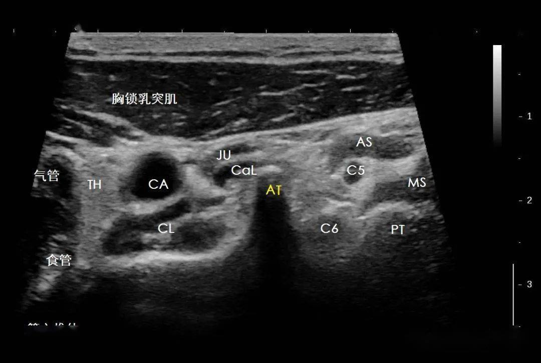 超声解剖61颈动脉结节
