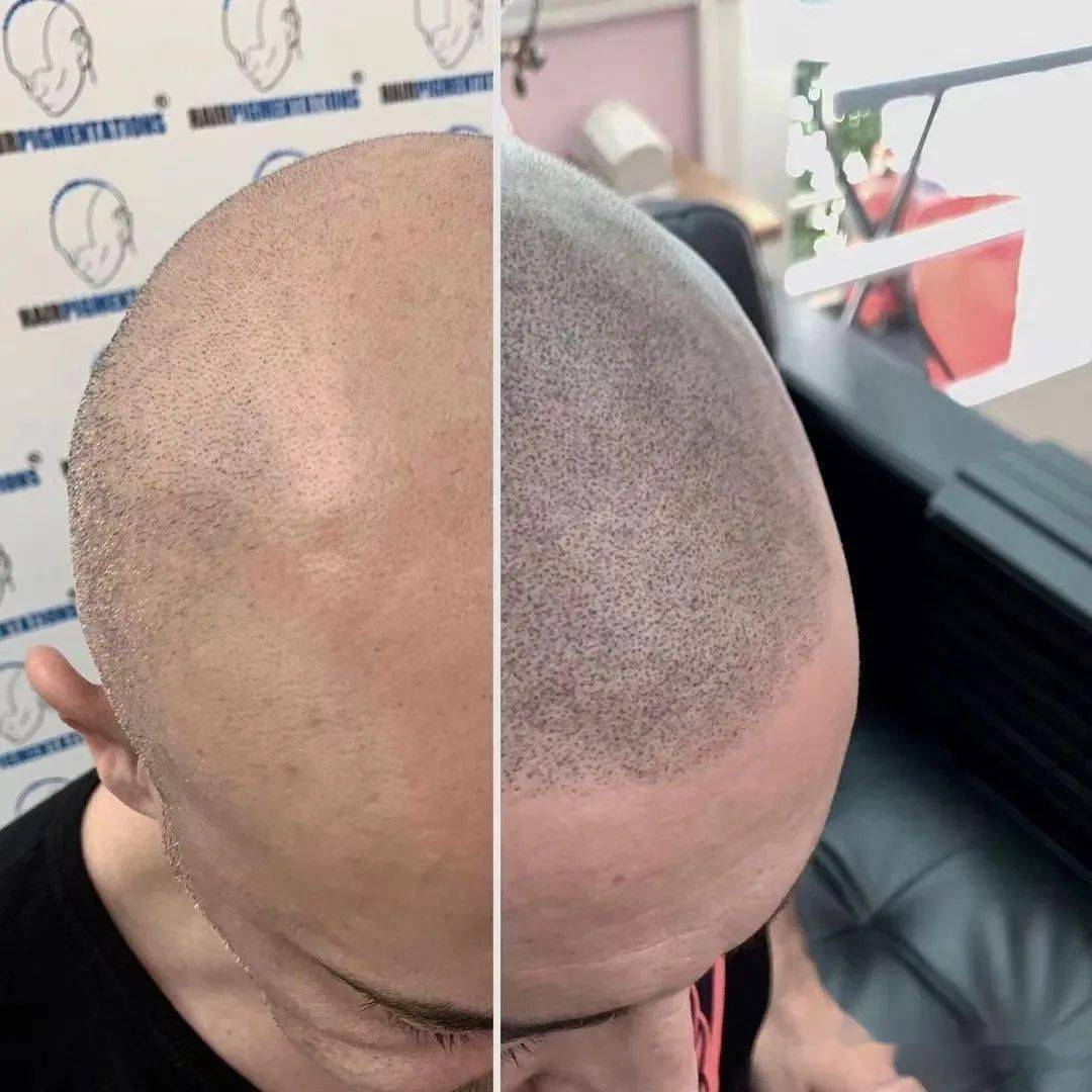 用纹身代替"植发",真的可行吗?_头皮_头发_杨幂