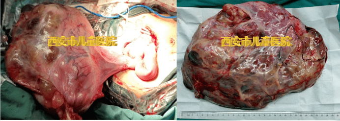 警惕您家宝宝真的是青蛙肚吗小心是肿瘤