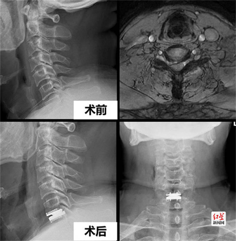 前路|华西骨科实现人工颈椎间盘置换术日间手术 缩短5到6天住院时间