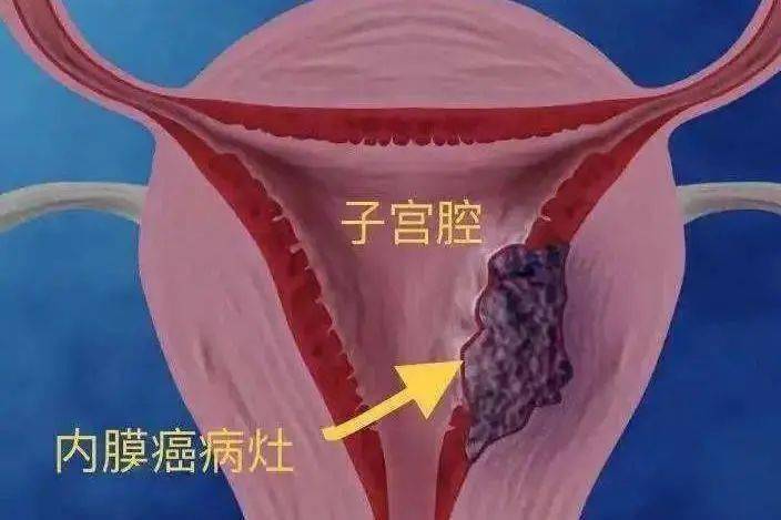 子宫内膜癌患者淋巴结转移状态是figo手术