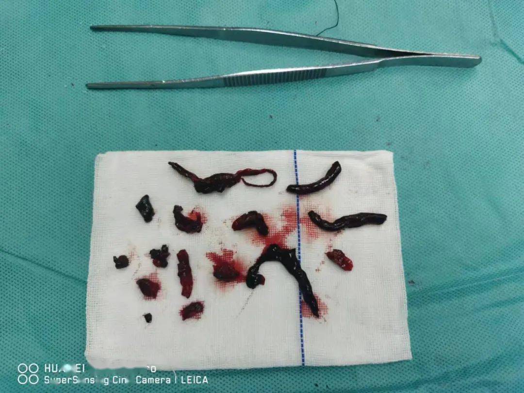 庆祝建院50周年诊疗动态95岁高龄老人下肢栓塞齐医附属二院血管外科