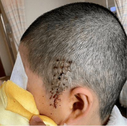 华山精准医疗再升级混合现实技术助力微创锁孔颅底手术