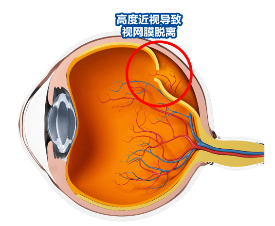 手术|高度近视者突然眼前发黑，小心高致盲性视网膜脱离！