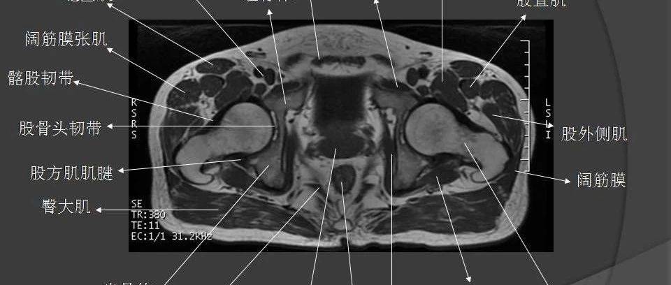 骨盆肌肉解剖MRI标识_手机搜狐网