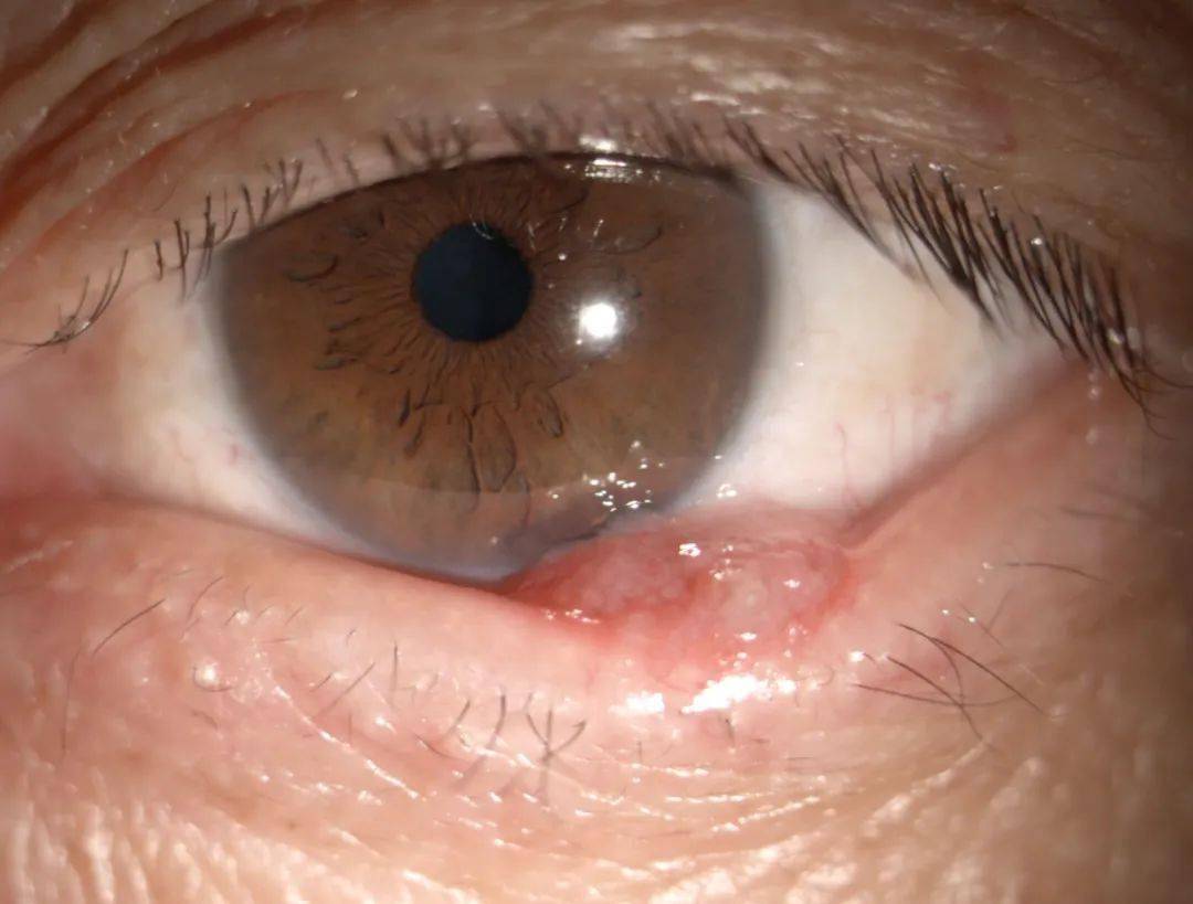 眼睑癌早期症状图片图片