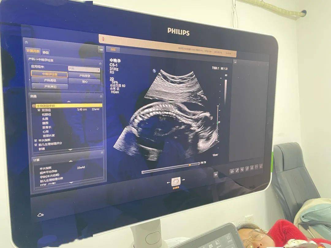 让诊疗soeasy区妇计中心引进新型飞利浦彩超旗舰机