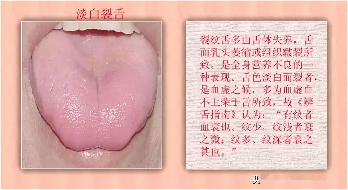 舌诊科普中医医生总看舌头都在看什么奉上珍贵的舌诊图谱