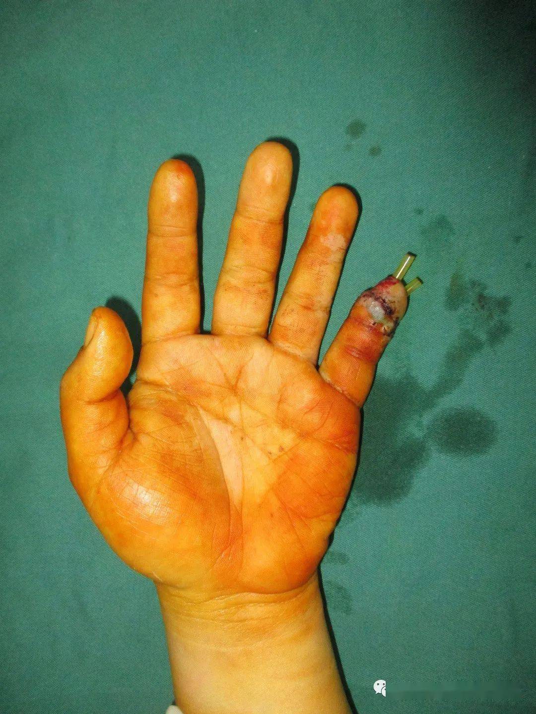 残端手术后的手指图图片