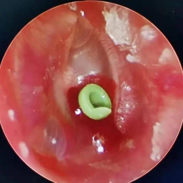 爱耳日警惕儿童听力下降不容忽视的潜在杀手分泌性中耳炎