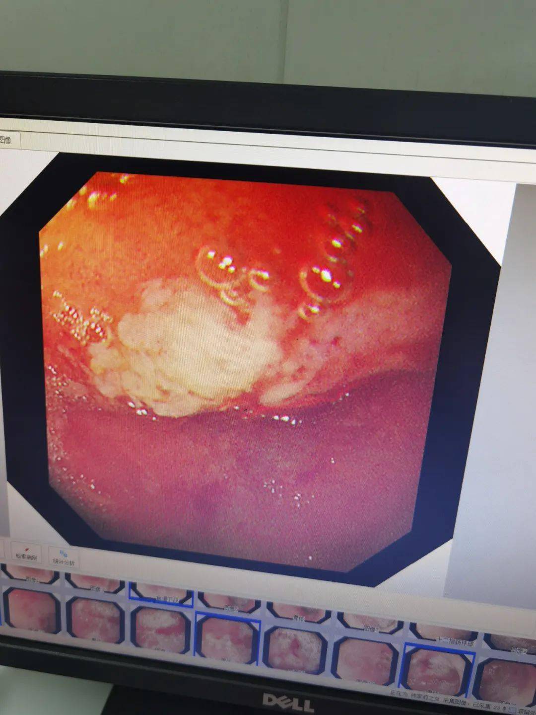 新设备探胃小宝宝出生第二天大吐血原因找到了