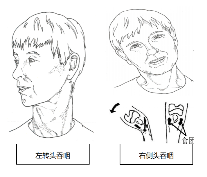 语言认知吞咽障碍之常用治疗方法