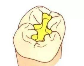 嵌体or高嵌体之间不单是一个字的差别