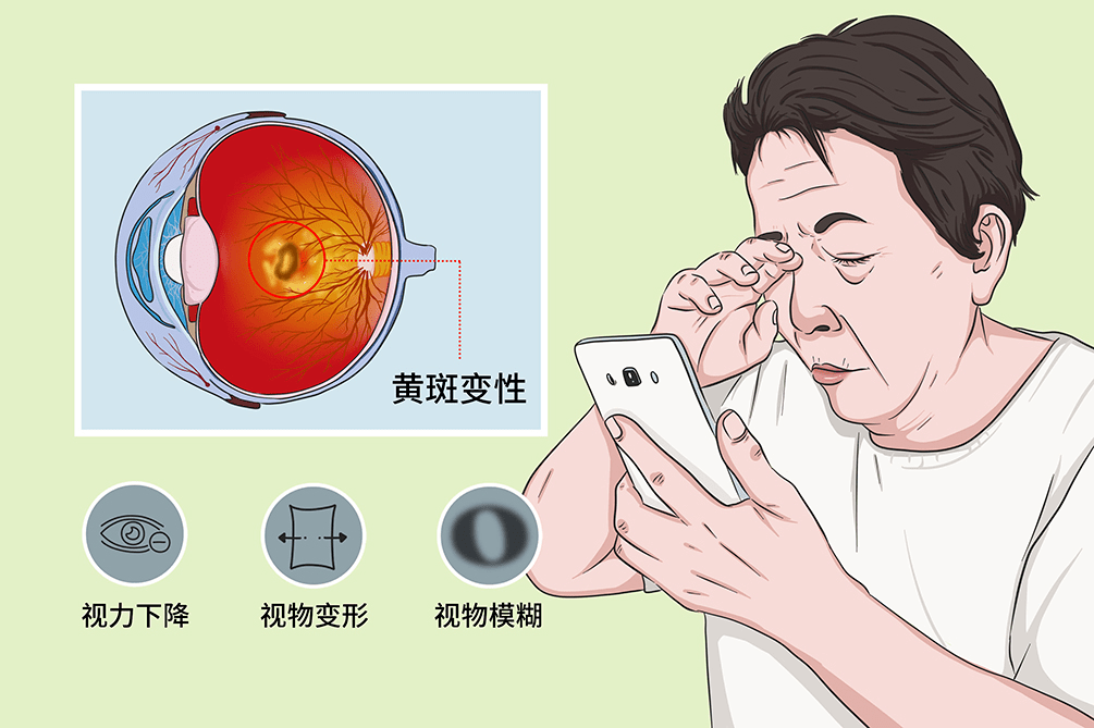 不可忽視的眼底疾病年齡相關性黃斑病變