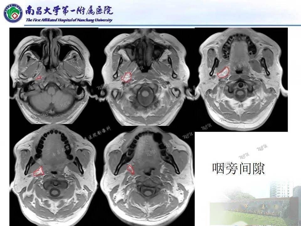 咽旁間隙,你別動!_影像_常讀_平臺