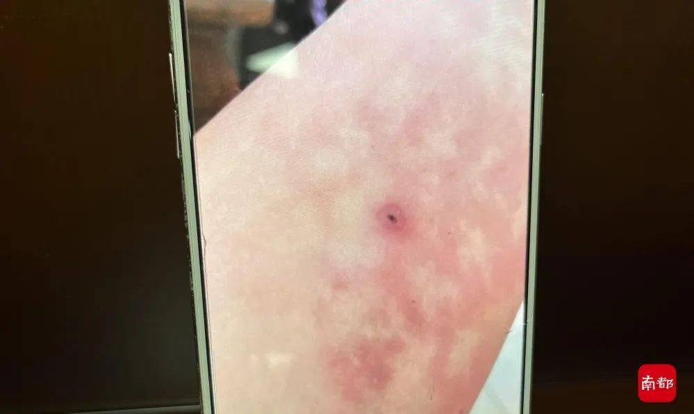 被马蜂蜇伤险些瘫痪,医生竟选择"引火上身"_陈姨_陈楚云_火龙