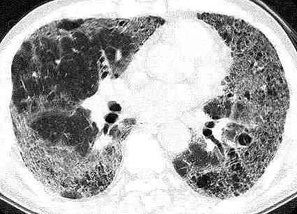 间质性肺炎ct图片特点图片