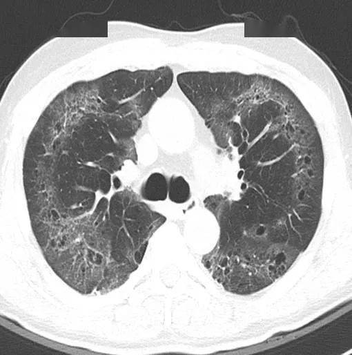 间质性肺炎ct图片特点图片