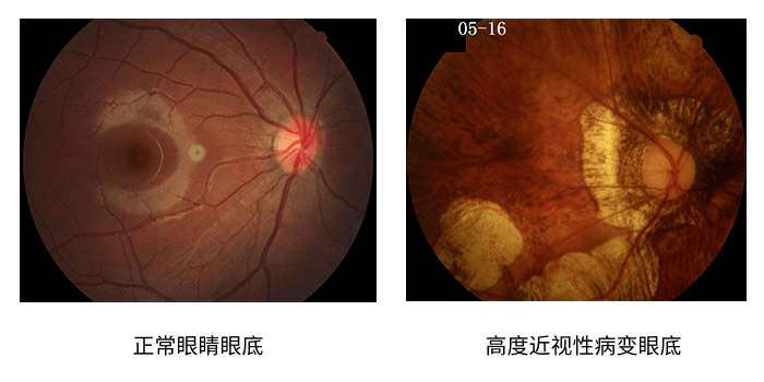 脉络膜透见图片