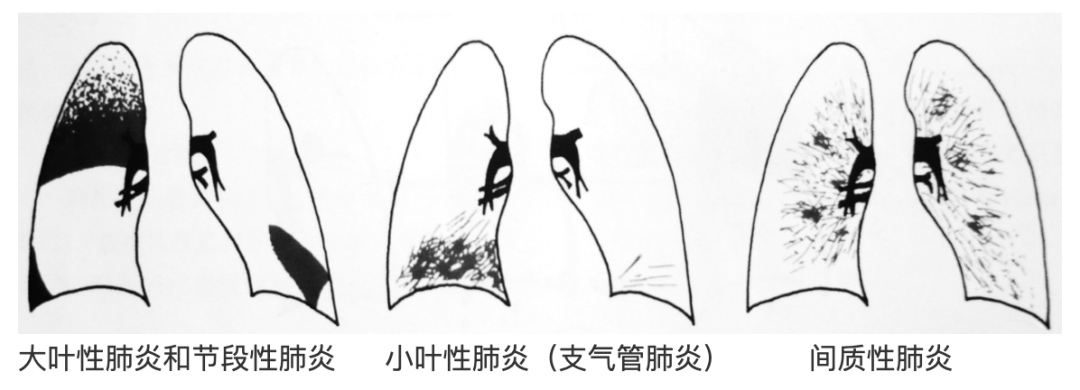 肺炎x光片图解图片