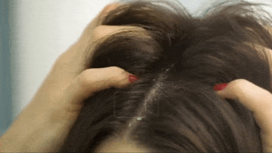 头皮头屑暴增？头皮扣下“白泥”？用Ta,帮你揪出头屑“内鬼”！清爽柔顺，发量翻一番！