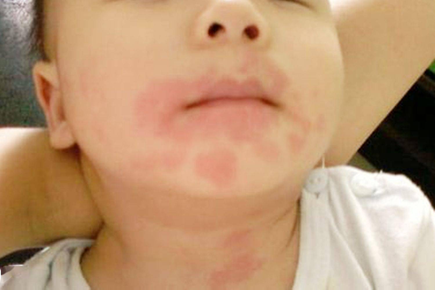 儿童营养师:5种高营养的辅食添加要慎重,别等孩子过敏才后悔