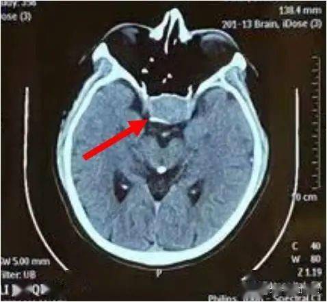 团队|北京协和医院多学科团队紧急采用术中MRI，让垂体瘤卒中患者重获光明