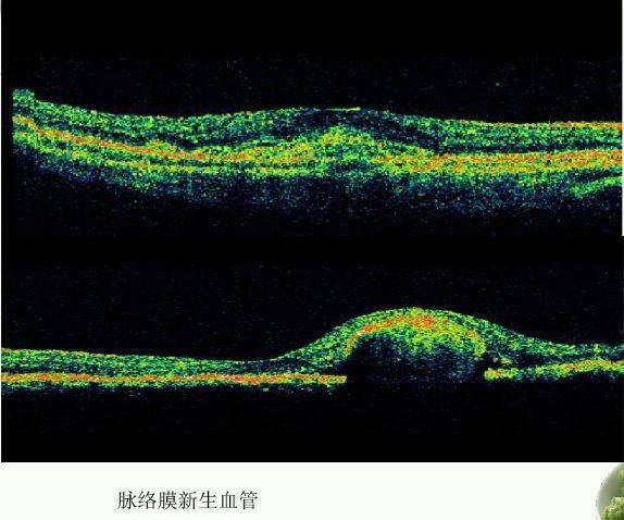 眼科新手必備oct基礎知識