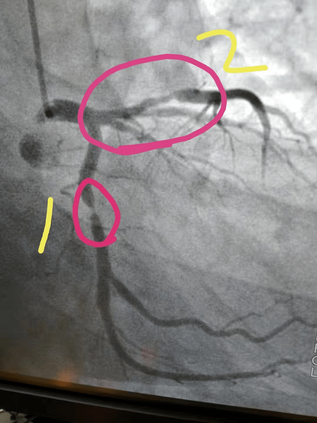 随后做了心脏造影,大家可以看看,黄色1号这根血管,当时重度狭窄98%