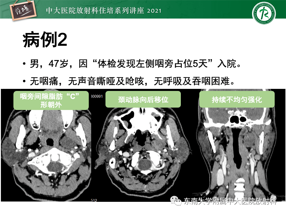 咽旁間隙腫瘤的定位與診斷_全網_影像_解剖圖