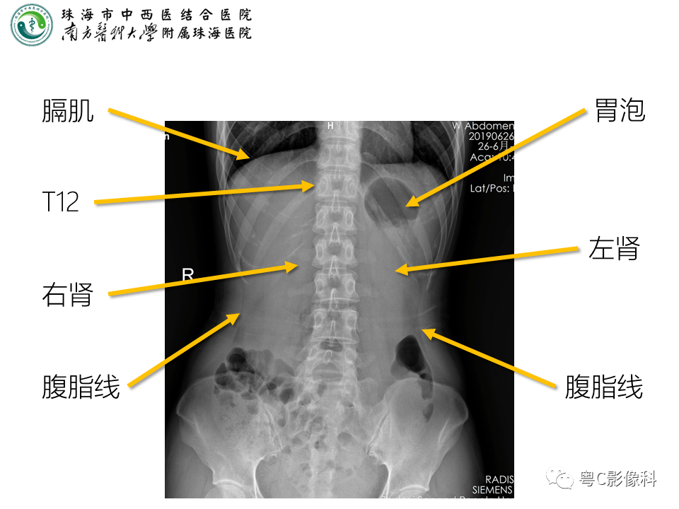 腹平片x线摄影及常见急腹症的诊断