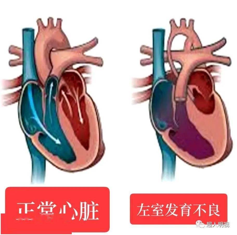 左室发育不良综合征