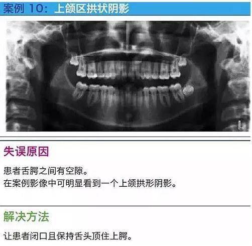 口腔全景片25个解剖点图片