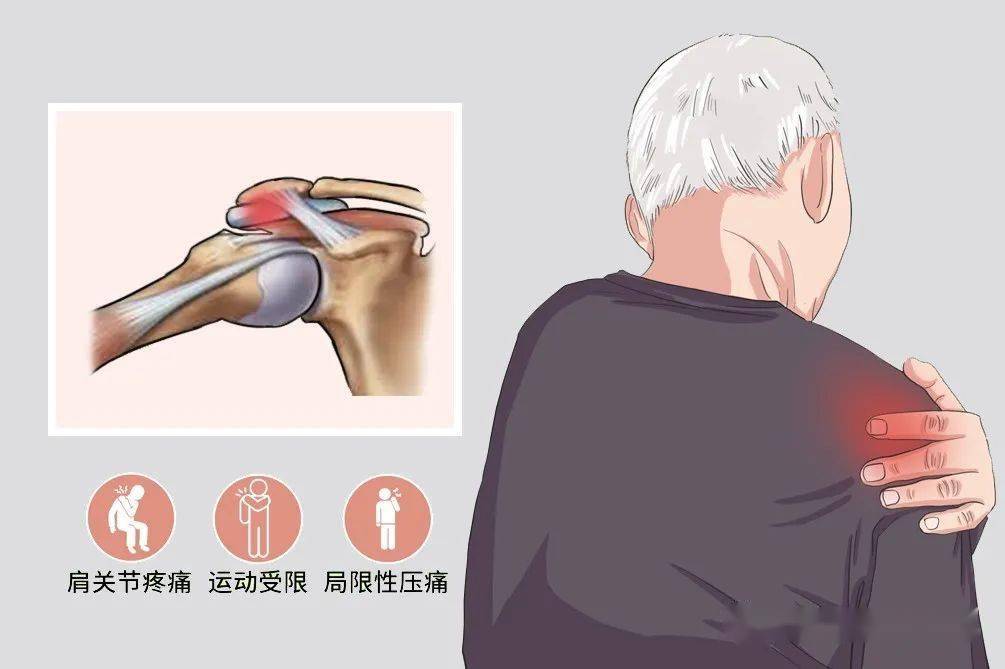 肩峰下滑囊炎_治疗_活动_症状