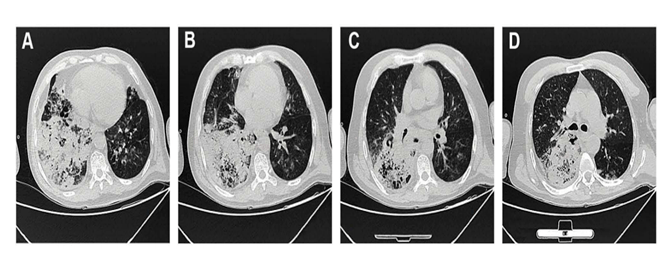 铜绿假单胞菌下呼吸道感染诊治