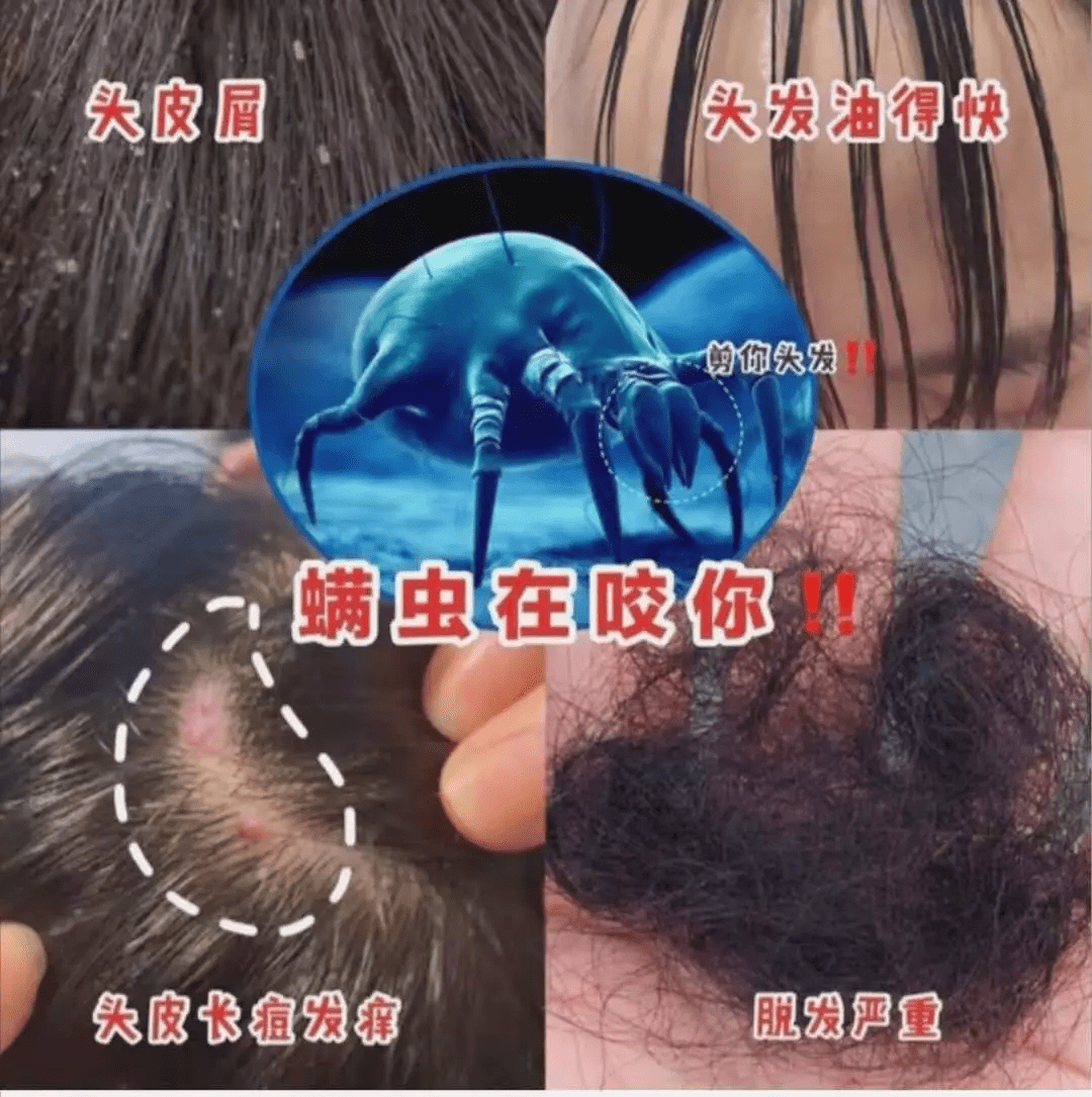 油脂头上抠下的 「白泥」居然不是头皮屑？掉头发头油大多是因为它？