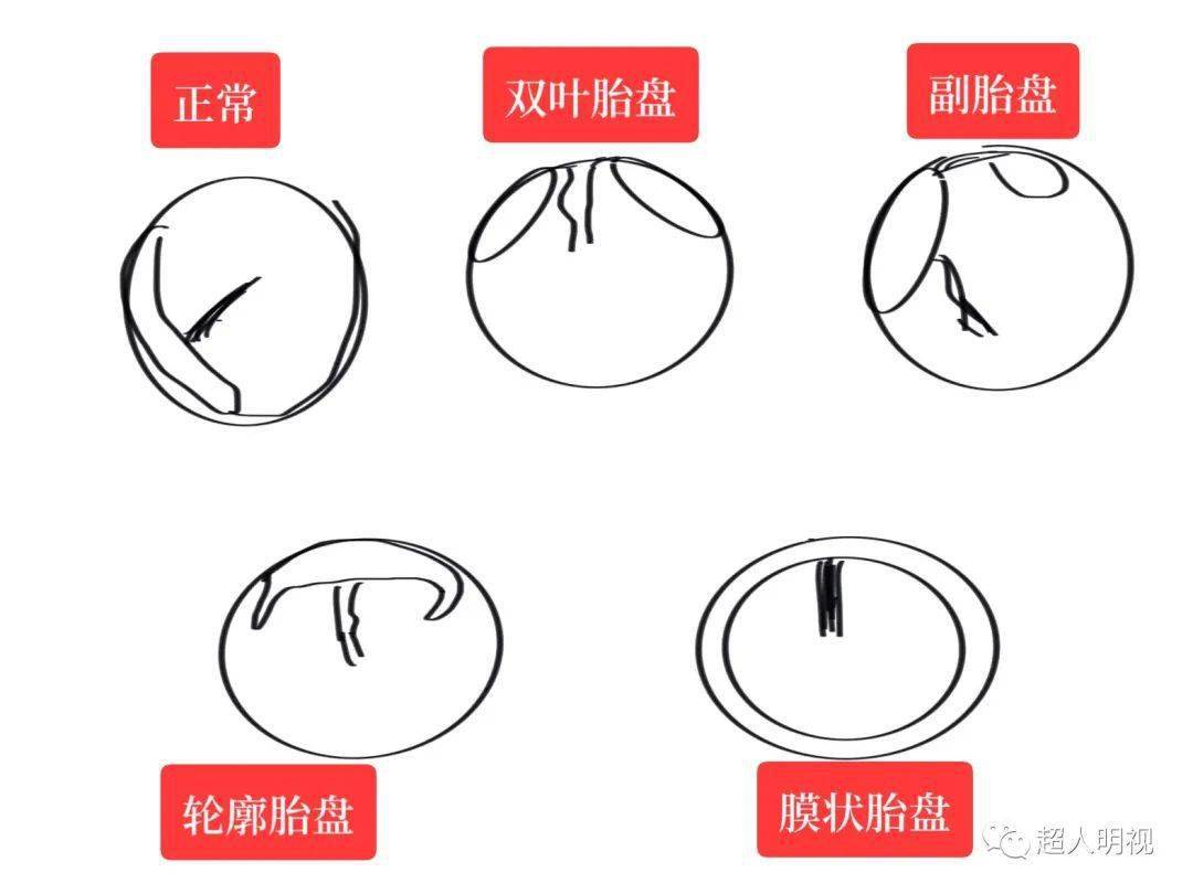 胎盘的形状有几种图图片