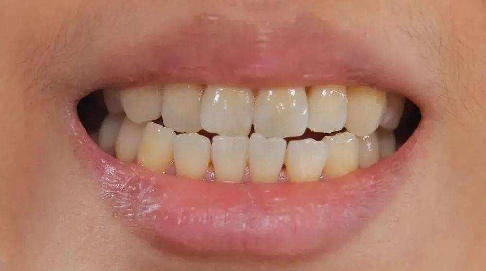 (不是牙缝)_牙齿_牙龈_图片