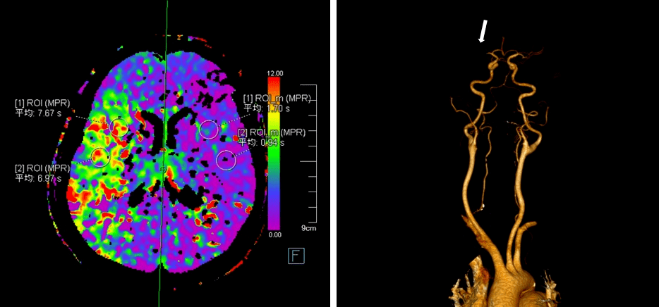 头颅ctp cta:右侧大脑中动脉供血区低灌注,右侧大脑中动脉闭塞.