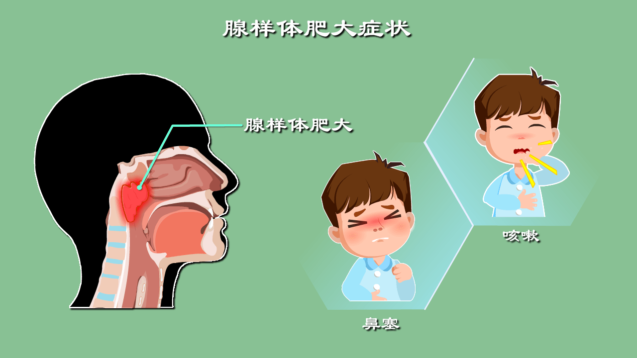 4歲寶寶打呼嚕不是事還會影響發育變醜腺樣體肥大究竟是啥