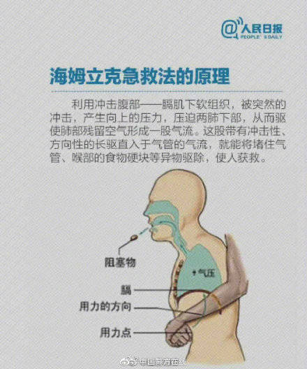 海姆|一定要学！海姆立克急救法