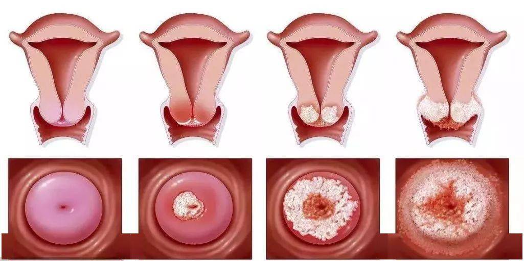 宫颈炎发展到宫颈癌图片
